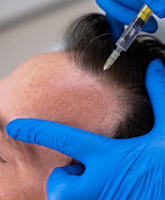 Scalp-Micropigmentation
