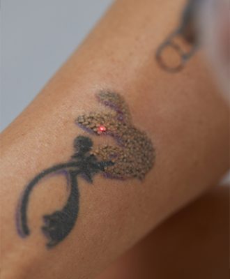 Tattoo-Removal